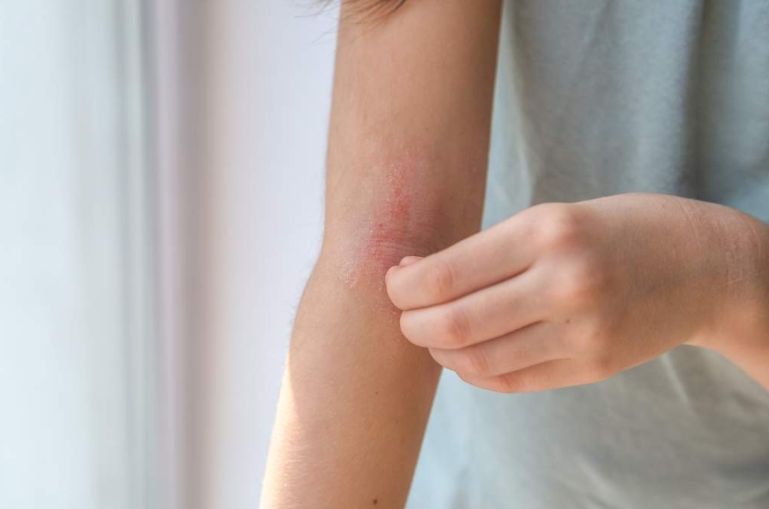 Накупали «зуд»: россияне массово заражаются церкариозом в водоемах